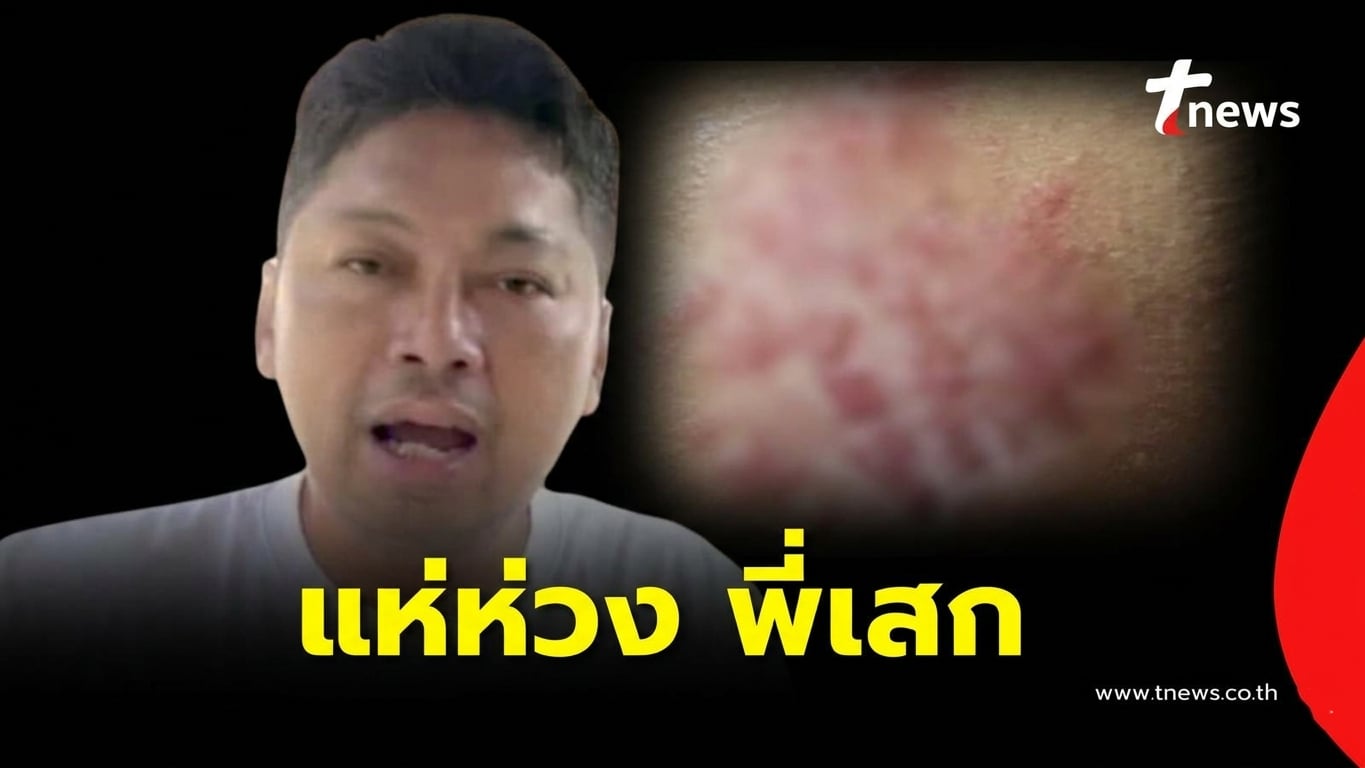 น่าห่วง “เสก โลโซ” ตุ่มใสขึ้นแขน หมอเตือนรีบรักษาภายใน 72 ชม.